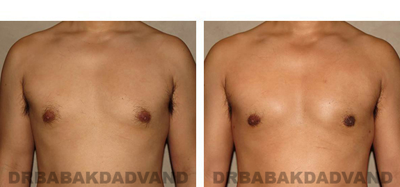 Before and After Photos |Gynecomastia| - 36 year old man, - front view