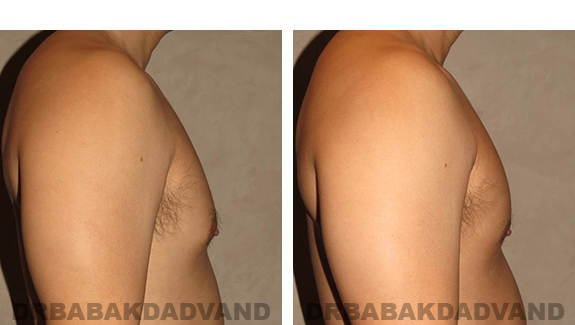 Before and After Photos |Gynecomastia| - 36 year old man, - right side view