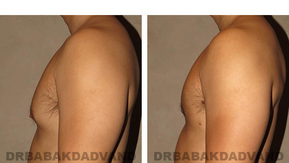 Before and After Photos |Gynecomastia| - 36 year old man, - left side view