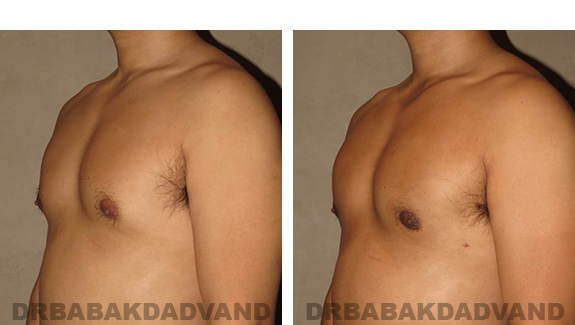 Before and After Photos |Gynecomastia| - 36 year old man, - left side, oblique view