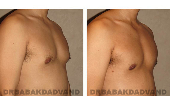 Before and After Photos |Gynecomastia| - 36 year old man, - right side, oblique view