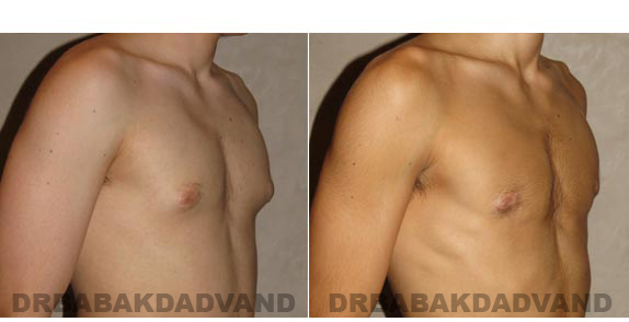 Breast-Gynecomastia: Before and After Photos. 17 year old man, -right side, oblique view