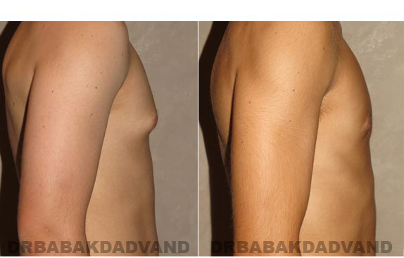 Breast-Gynecomastia: Before and After Photos. 17 year old man, -right side view