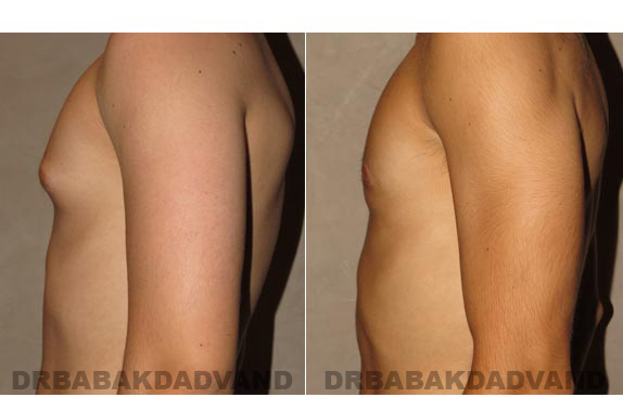 Breast-Gynecomastia: Before and After Photos. 17 year old man, -left side view