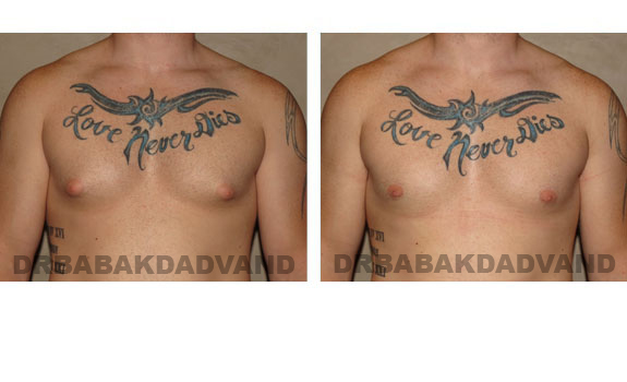 Breast-Gynecomastia: Before and After Photos. 24 year old man, front view