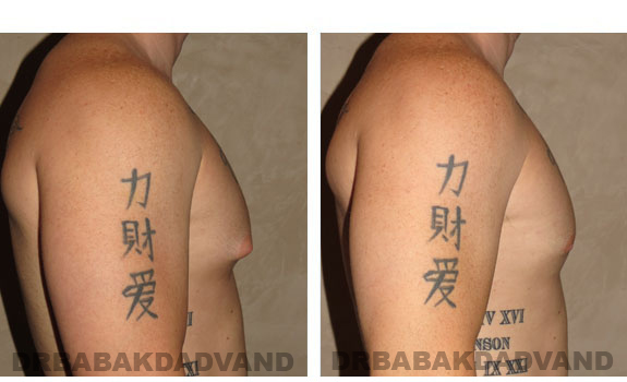 Breast-Gynecomastia: Before and After Photos. 24 year old man, right side view