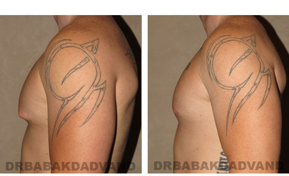 Breast-Gynecomastia: Before and After Photos. 24 year old man, left side view