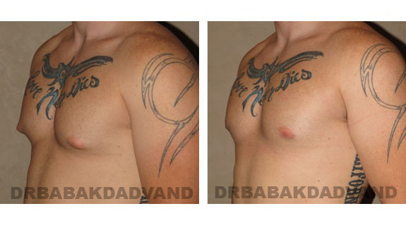 Breast-Gynecomastia: Before and After Photos. 24 year old man, left side, oblique view