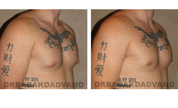 Breast-Gynecomastia: Before and After Photos. 24 year old man, right side, oblique view