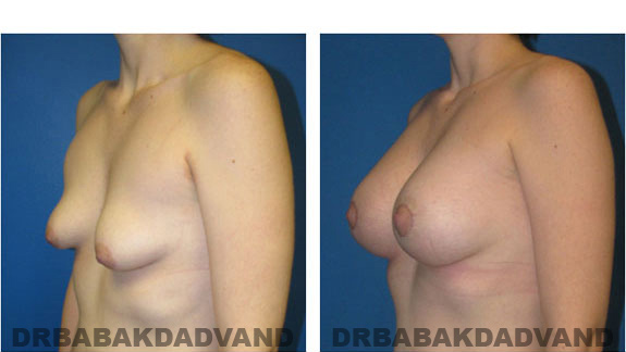 Before and After Photos. Breast-Breastlift: - 22 year old female, left side, oblique view