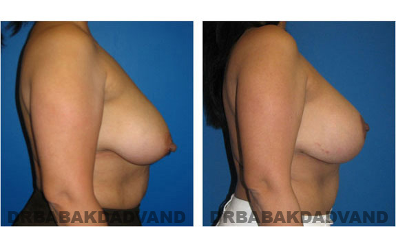Before and After Photos. Breast-Breastlift: - 43 year old female, right side view