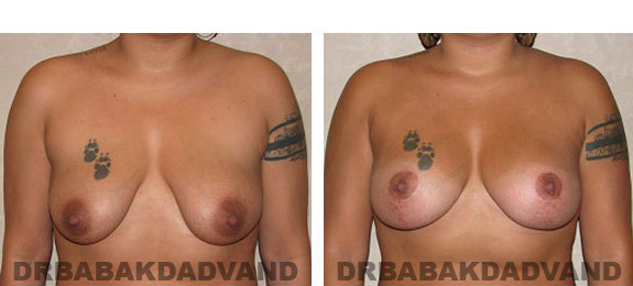 Before and After Photos. Breast-Breastlift: - 26 year old female, front view