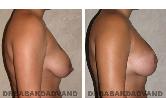 Before and After Photos. Breast-Breastlift: - 26 year old female, right side view
