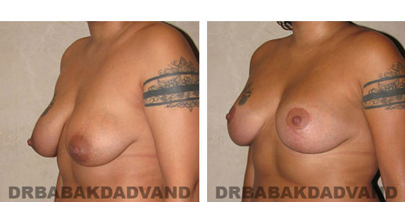 Before and After Photos. Breast-Breastlift: - 26 year old female, left side, oblique view