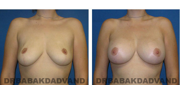 Before and After Photos. Breast-Breastlift: - 24 year old female, front view