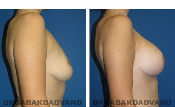 Before and After Photos. Breast-Breastlift: - 24 year old female, right side view