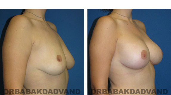 Before and After Photos. Breast-Breastlift: - 24 year old female, right side, oblique view