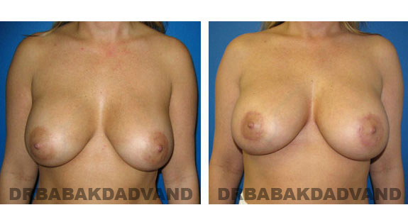 Before and After Photos. Breast-Breastlift: - 42 year old female, front view