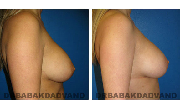 Before and After Photos. Breast-Breastlift: - 42 year old female, right side view