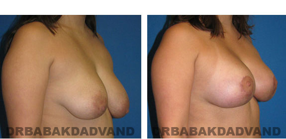 Before and After Photos. Breast-Breastlift: - 28 year old female, right side, oblique view