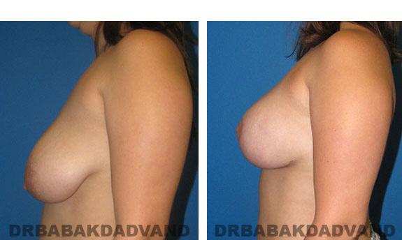 Before and After Photos. Breast-Breastlift: - 28 year old female, left side view