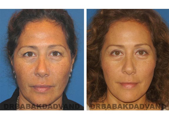 Before - After Photos |Browlift| 57 year old female, - front view