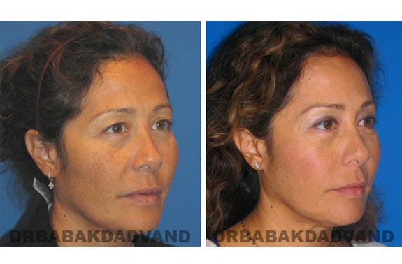 Before - After Photos |Browlift| 57 year old female, - right side,oblique view