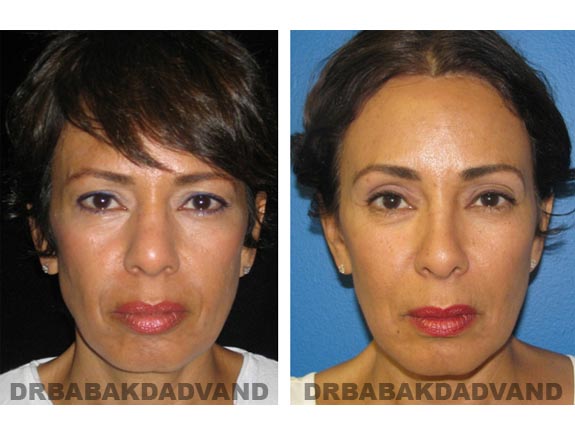 Before - After Photos |Browlift| 55 year old female, - front view