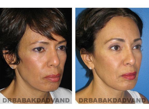 Before - After Photos |Browlift| 55 year old female, - right side,oblique view
