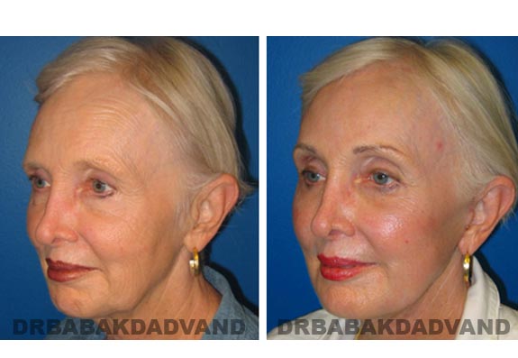 Before - After Photos |Browlift| 67 year old female, - left side,oblique view