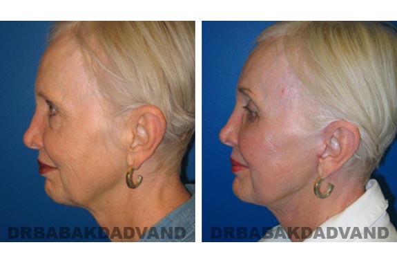 Before - After Photos |Browlift| 67 year old female, - left side