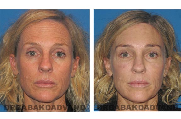 Before - After Photos |Browlift| 50 year old female, - front view