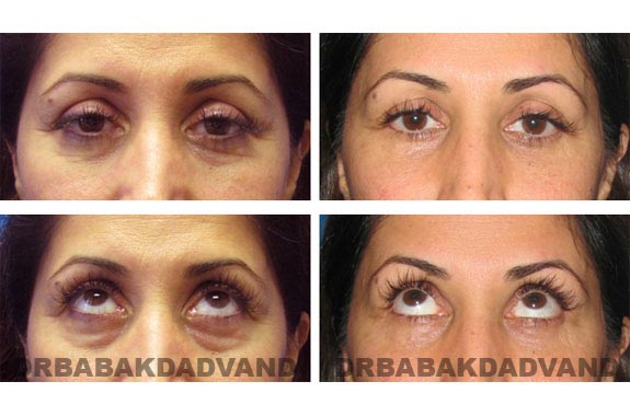 Before - After Photos |Eyelid| 47 year old female, - front view