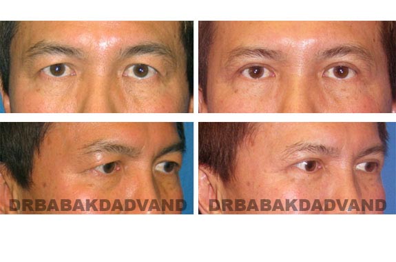 Before - After Photos |Eyelid| 57 year old male, - front view; oblique view