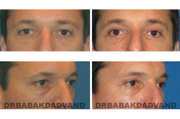 Before - After Photos |Eyelid| 36 year old male, - front view; right side, oblique view