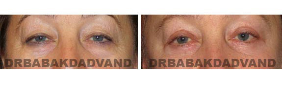 Before and After Photos |Eyelid| 56 year old female, - front view