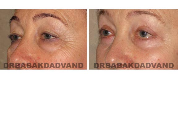 Before and After Photos |Eyelid| 56 year old female, - left side, oblique view
