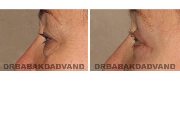 Before and After Photos |Eyelid| 56 year old female, - left side view