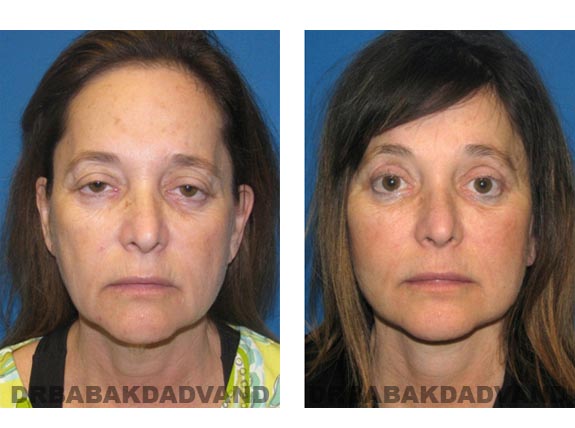Before - After Photos |Facelift| 55 year old female, - front view