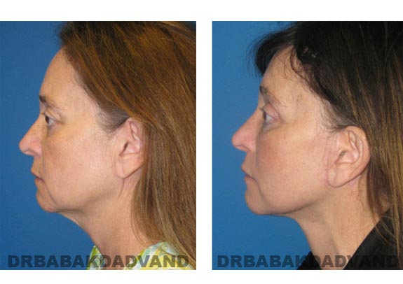 Before - After Photos |Facelift| 55 year old female, - left side view