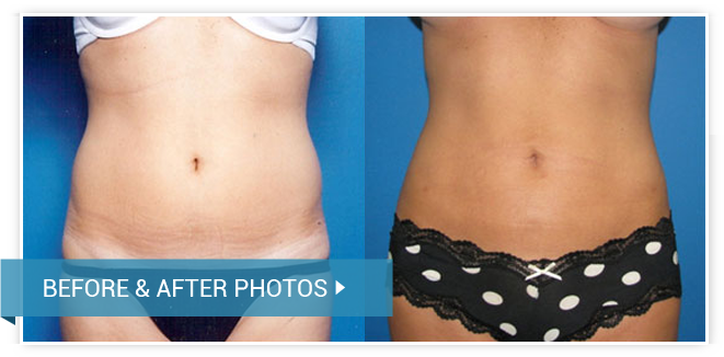 Liposuction. Before and After photos female front view