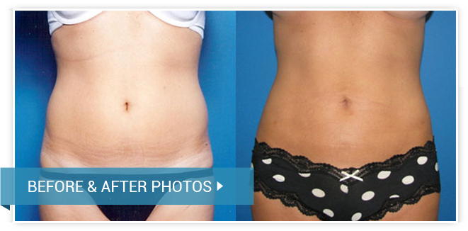 Best Bra Fat Liposuction Los Angeles & Beverly Hills