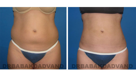 Before and After Photos |Liposuction| 27 year old woman, - front view