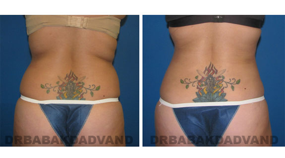 Before and After Photos |Liposuction| 27 year old woman, - back view