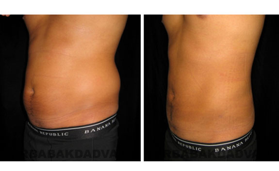 Before and After Photos |Liposuction| 32 year old male, - left side,oblique view