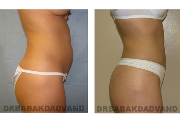 Before and After Photos |Liposuction| 40 year old female, - right side view
