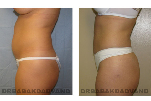 Before and After Photos |Liposuction| 40 year old female, - left side view