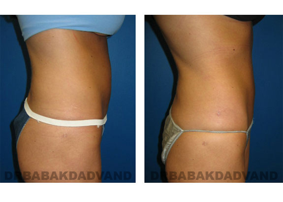 Before and After Photos |Liposuction| 32 year old woman, - right side view