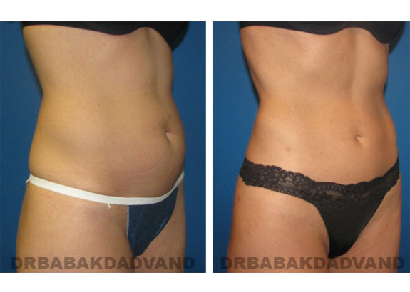 Before and After Photos |Liposuction| 33 year old woman, - right side, oblique view