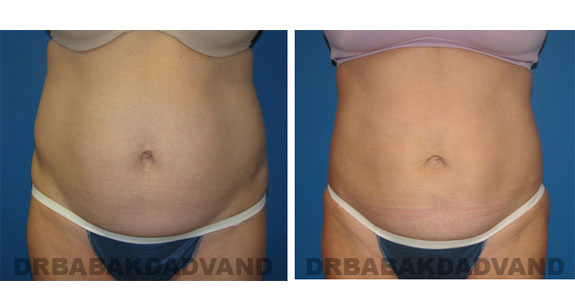 Before and After Photos |Liposuction| 43 year old woman, - front view